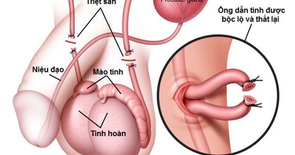 THẮT ỐNG DẪN TINH - NHỮNG THẮC MẮC THƯỜNG GẶP