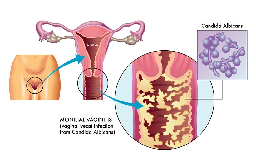 NHIỄM NẤM CANDIDA ÂM ĐẠO