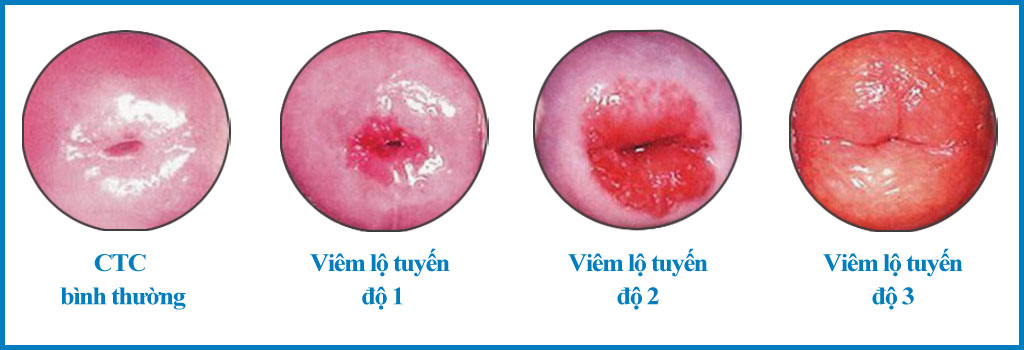 PHÁT HIỆN LỘ TUYẾN CỔ TỬ CUNG: CÓ NHẤT THIẾT PHẢI ĐỐT?