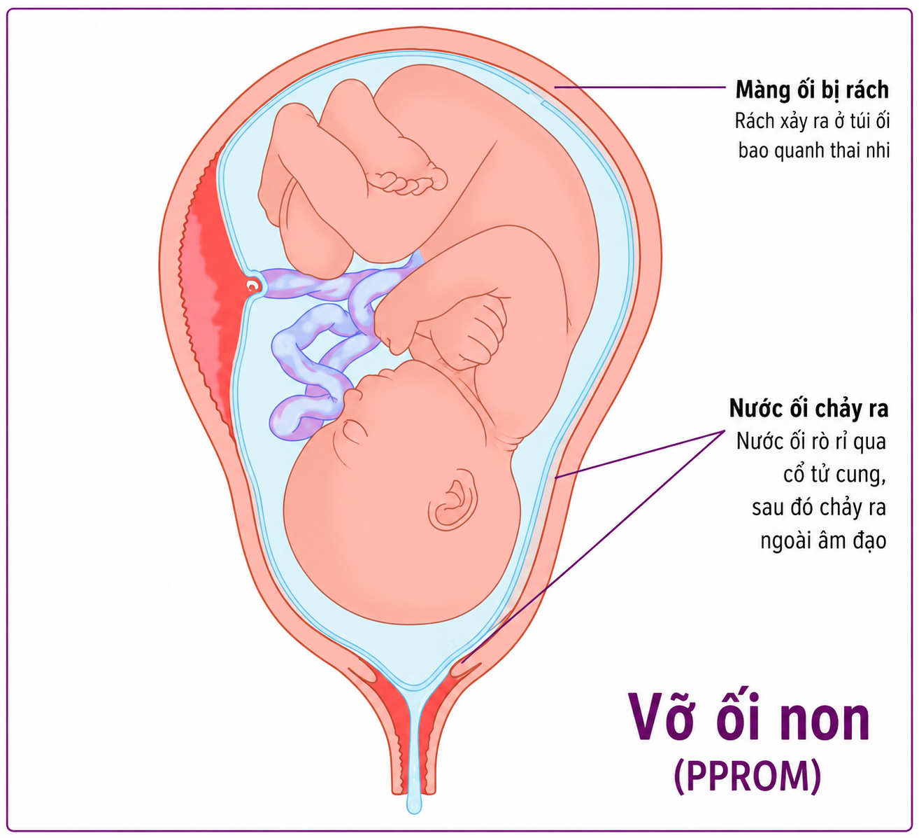 ỐI VỠ NON VÀ CÁCH XỬ TRÍ
