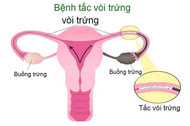 HIẾM MUỘN DO TẮC VÒI TRỨNG